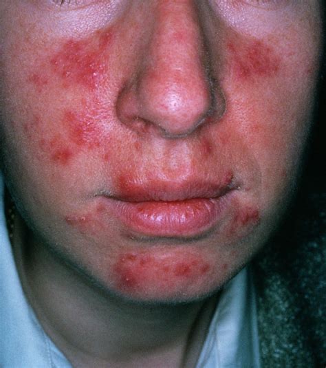 Rosacea Photograph By Cnri Science Photo Library Pixels