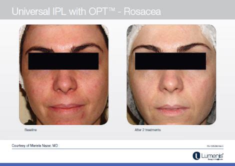 Latest Laser Ipl Treatment For Rosacea Quinn Clinics