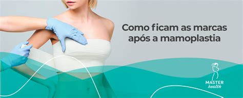 Cicatriz Da Mamoplastia Como Ficam As Mamas Blog Master Health