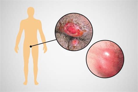 Linfogranuloma Venéreo O Que é Sintomas Transmissão E Tratamento