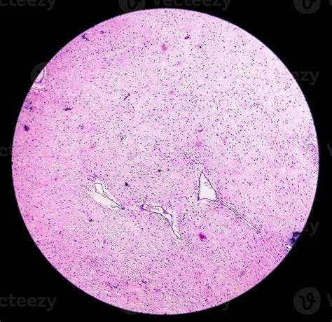 Histology, Peritoneal inclusion cyst. Paraovarian cysts, hydrosalpinx ...