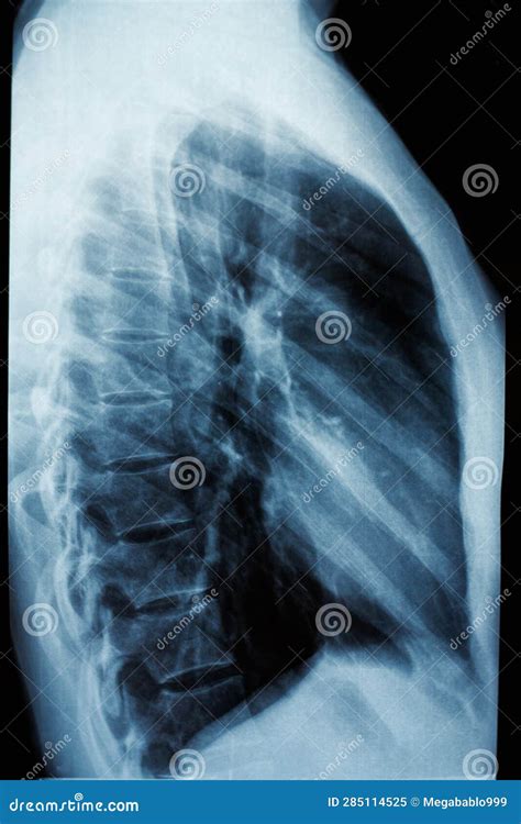 Diagnosis With X Ray Fluorography Of The Human Chest Side View Stock