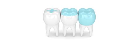 What Are The 4 Types Of Fillings