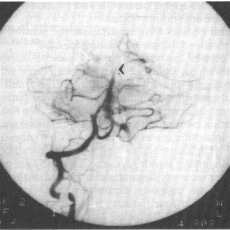 Thrombosis Of The Basilar Artery Patient 10 Download Scientific Diagram