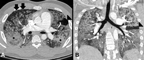 Characteristic Imaging Findings In Pulmonary Fat Embolism Syndrome Fes