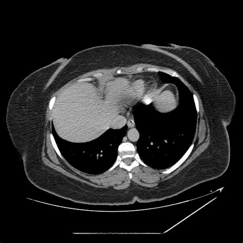 Atypical hepatic hemangioma - bright dot sign (Radiopaedia 63798-72527 ...