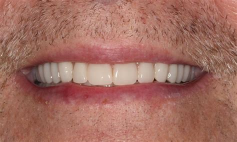 Implant Dentures | Dr. Robert Appel | General Dentist Houston TX