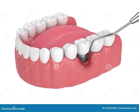 3d Render Of Human Jaw With Peri Implantitis Disease And Periodontal