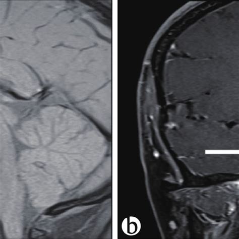 A T Weighted Mri Sagittal Images Showing Large Intrasellar Mass