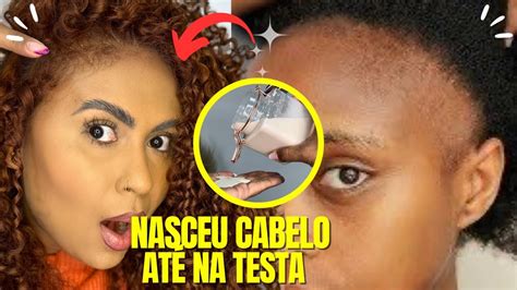 Use Isso E Pare A Queda De Cabelo Em Excesso Engrosse O Cabelo E