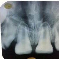 B: IOPA X-Ray after reattachment | Download Scientific Diagram