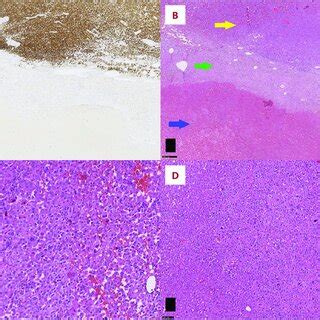 Postoperative Histopathological Examination A Hematoxylin And Eosin