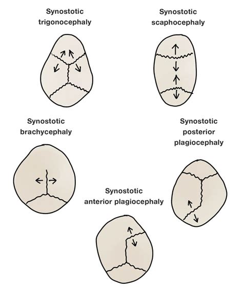 Image 2: An illustration of different skull deformities associated with ...