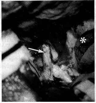 Operative photograph, showing decompressed optic nerve by unroofing of ...