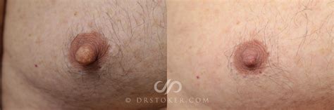 Male Nipple Reduction Before And After Photo Gallery Los Angeles CA