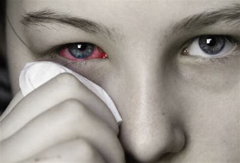 Pink Eye Symptoms and Treatment - Unbound