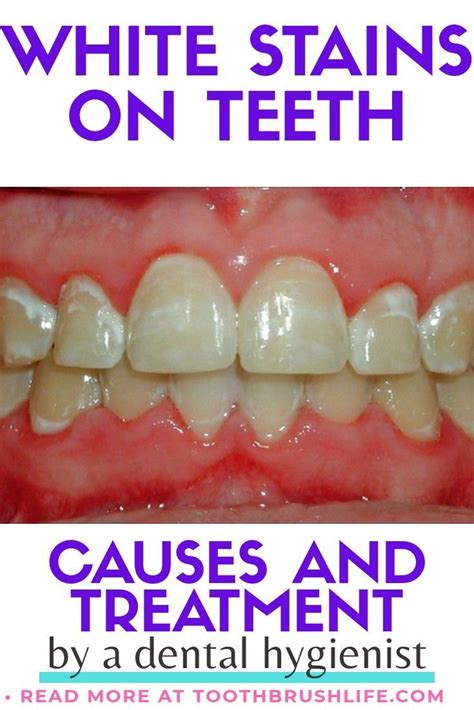 How To Get Rid Of Teeth Stains From Braces At Tyler Dean Blog