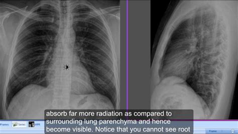 Differentiate Left And Right Hemidiaphragms On Chest X Ray Lateral View