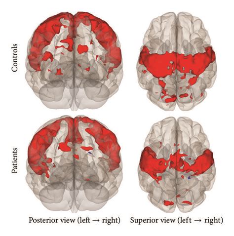 Functional Connectivity Map Of The Seed To Voxel Analysis For The Smn Download Scientific