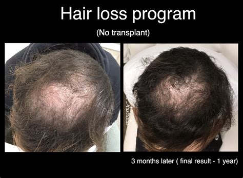 Hair Loss Melbourne Vista Clinic