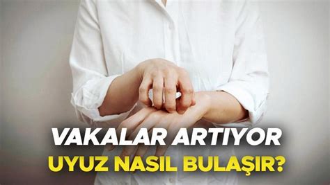 Uyuz belirtileri nelerdir nasıl geçer ve bulaşır Uyuz hastalığı nedir