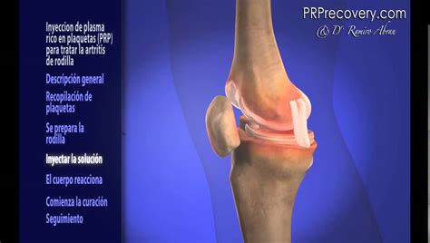 Tratamiento De Rodilla Con Prp Plasma Rico Youtube