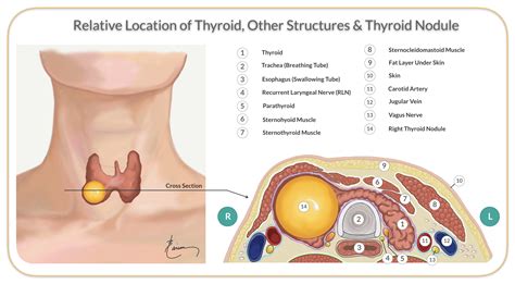 Thyroid Nodule Rfa Larian Md