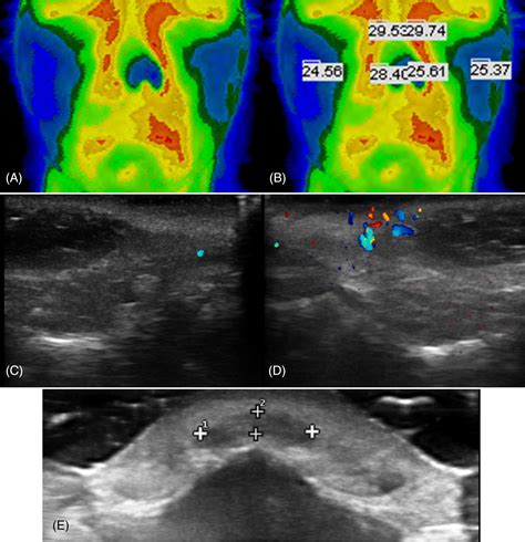 Management Strategies For Vascular Complications In Hyaluronic Acid Filler Injections A Case