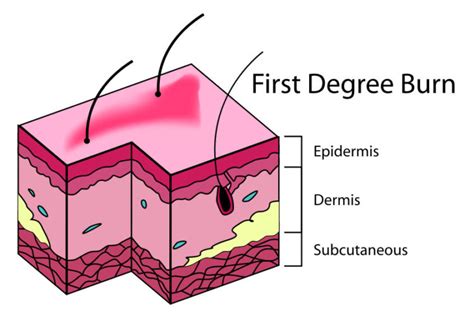 What's the difference between first, second & third-degree burns ...