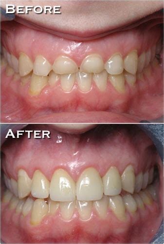 Indianapolis Crown-lengthening Surgery | Gingivectomy