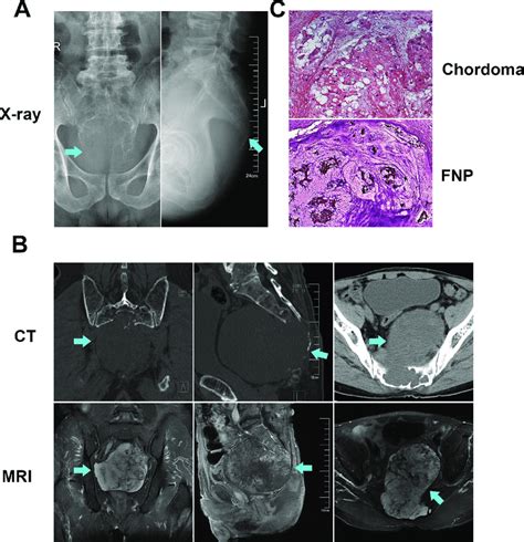 Radiological And Pathological Identification Of Chordoma X Ray Film