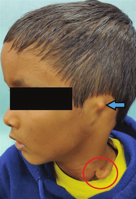 Frontal View Showing Cervical Chondrocutaneous Branchial Remnant