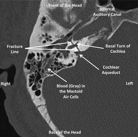 Axial Horizontal Ct Of The Right Temporal Bone Showing A Fracture