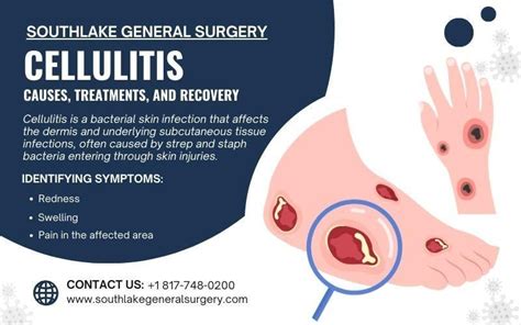 Cellulitis Causes Treatments And Recovery Rlaparoscopy