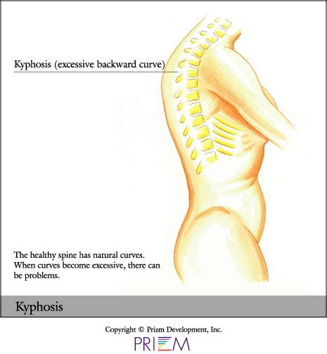 University Orthopedics - Kyphosis - Providence, Rhode Island