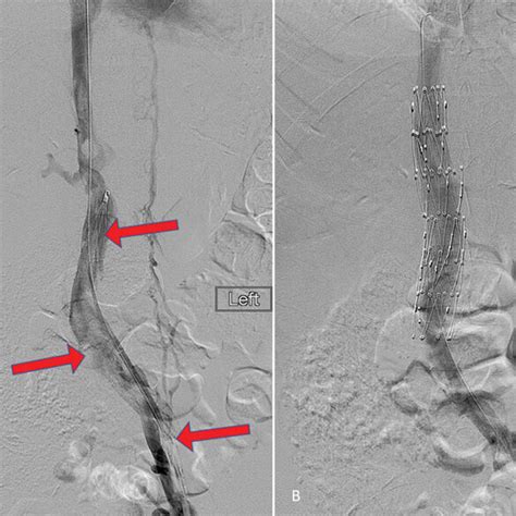 Case 1— Venacavogram With Filling Defect Representing Thrombus In