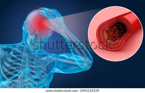 7 Anoxia Cause Images, Stock Photos & Vectors | Shutterstock