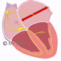 Ipertrofia Ventricolare Sinistra Nell Elettrocardiogramma