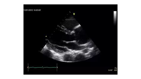 CT Aortogram For Aortic Dissection | PPT