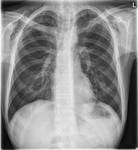 Spontaneous pneumomediastinum | Eurorad