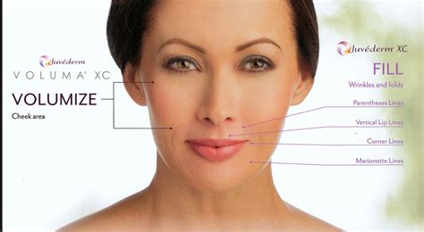 Juvéderm Voluma XC® | Medical Laser Solutions