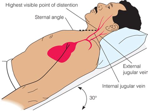 PNC IV Test 2 Hemodynamic Monitoring Flashcards Quizlet