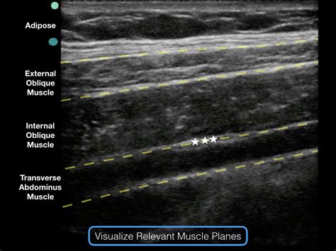 Tap Block Transverse Abdominus Plane Block — Highland Em Ultrasound Fueled Pain Management