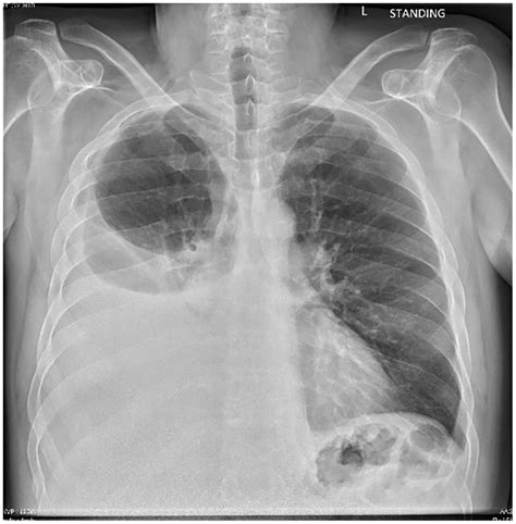 Rapidly Accumulating Pleural Effusion A Sequela Of Chronic