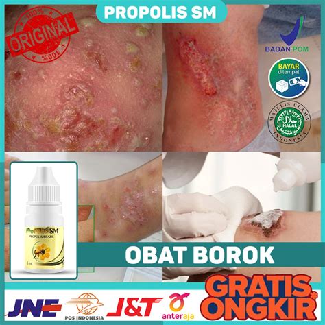 Jual Obat Borok Borok Bernanah Borok Berair Luka Bernanah Obat