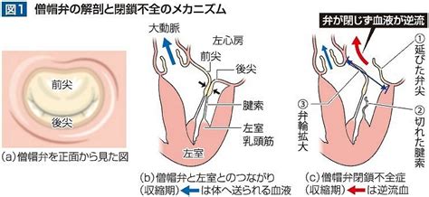 （4）僧帽弁閉鎖不全症に対する僧帽弁形成術について 津山中央病院心臓血管外科医長 剱持礼子｜岡山の医療健康ガイド Medica