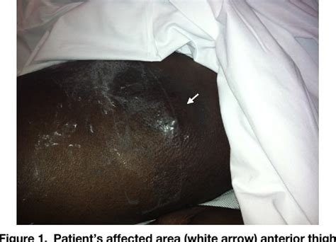 Figure From Diagnosis Of An Arteriovenous Av Graft Pseudoaneurysm