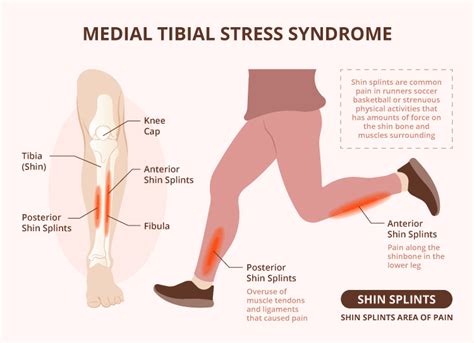 Medial Tibial Stress Syndrome Shin Splints Week Rehab