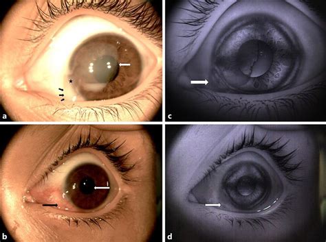 Anterior Segment Images Of The Left Eye Color And Red Free A