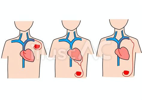 vectors   pacemaker implantation  lead color